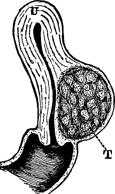 Illustration:
Fig. 19. U, Uterus. T, Tumor.