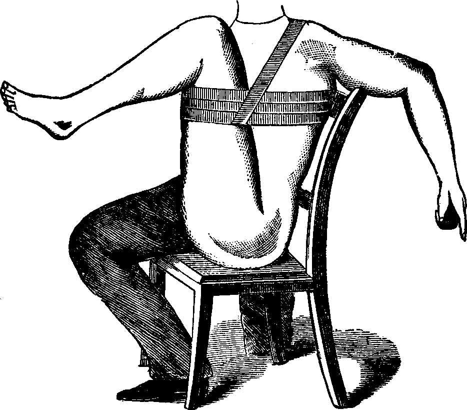 Illustration:
Mode of employing flexion for the arrest of hemorrhage from a wound located
between the thigh and knee.